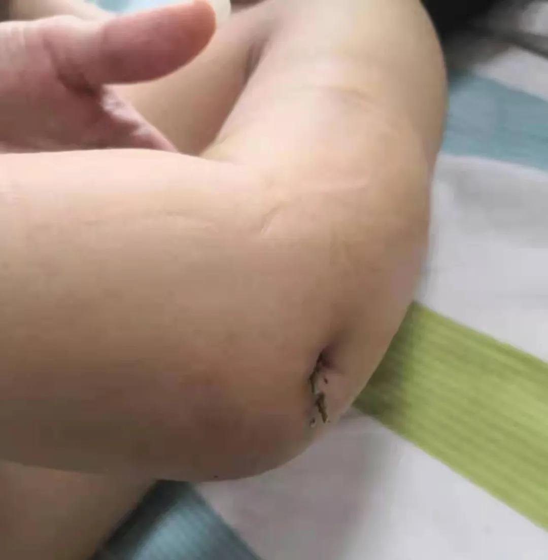 妙手复位治愈骨折